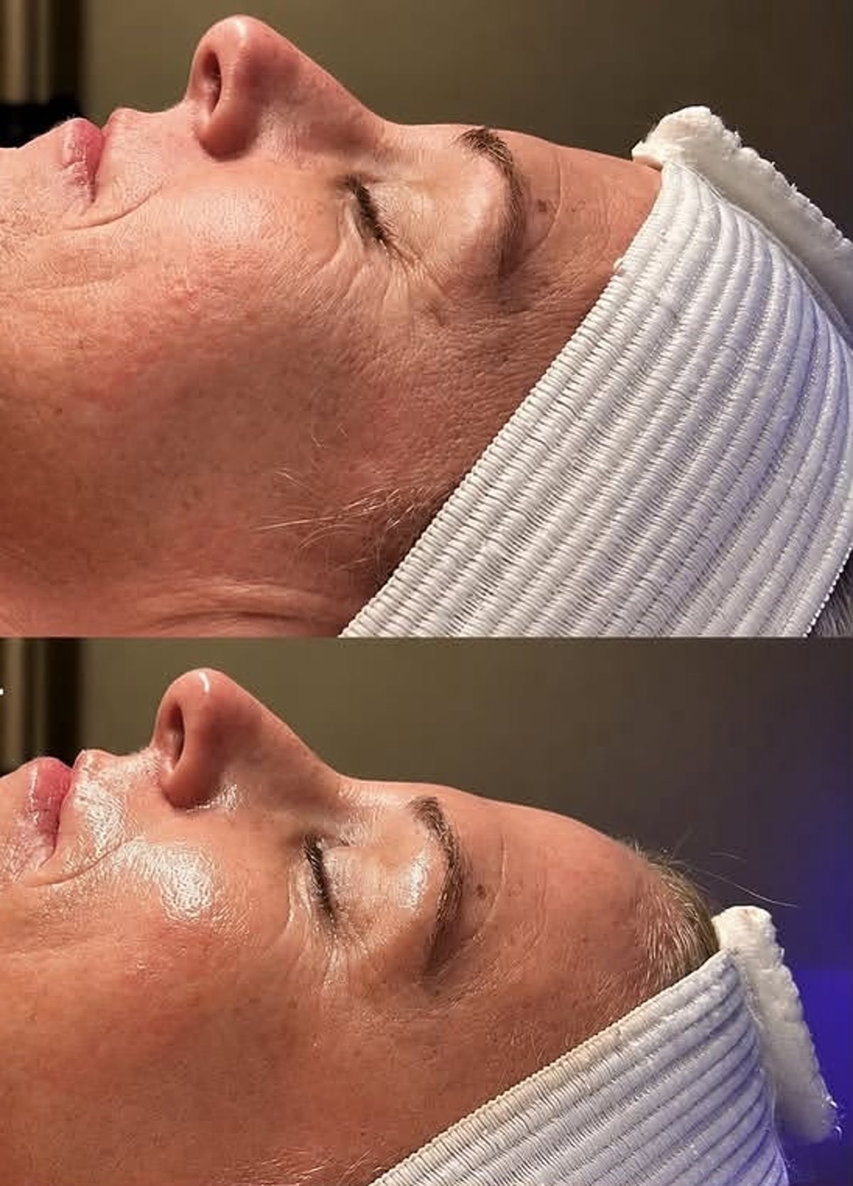 Metamorfoza - V-Tox Lift bezinwazyjny lifting